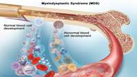 موثر بودن پیوند سلول های بنیادی بر بیماران سندرم میلودیسپلازی